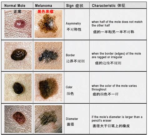 身體 痣|痣也可能会癌变！长在 3 个地方要注意